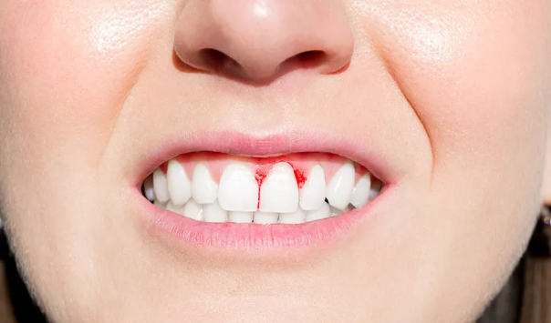 Choosing A Dental Office When Bleeding Gums Meet No Dental Insurance